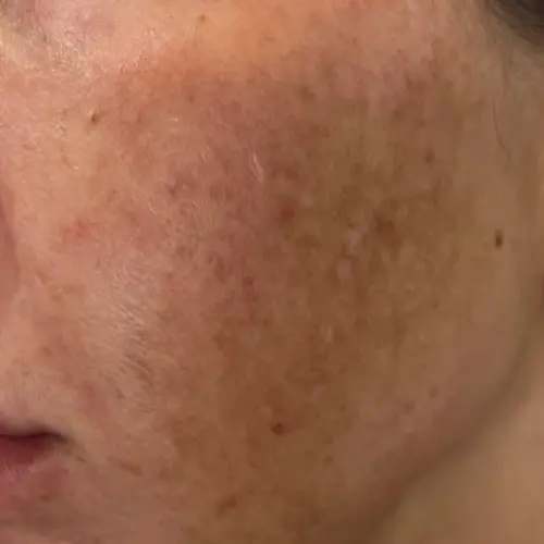 Before chemical peel melasma treatment at The Vancouver Aesthetician — visible melasma pigmentation and dark patches on skin