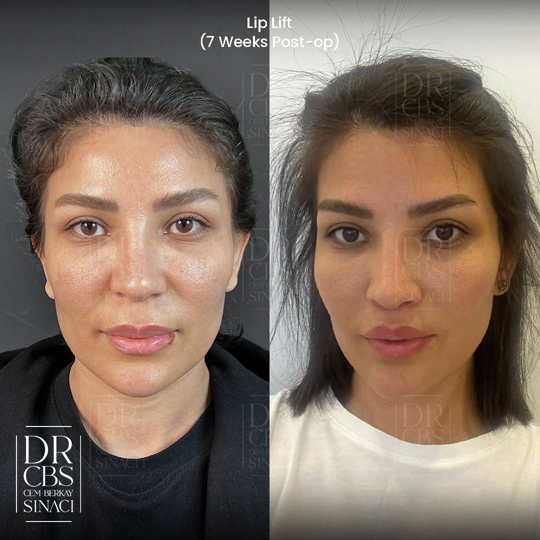 7 weeks result of lip lift before after front view