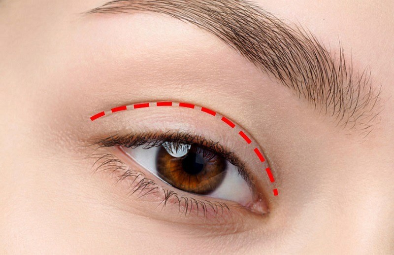Nhấn mí là phương pháp thẩm mỹ hiện đại, ít để lại biến chứng hay đau nhức