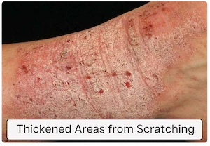 Thickened plaques from scratching