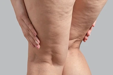 Lipedema Patient