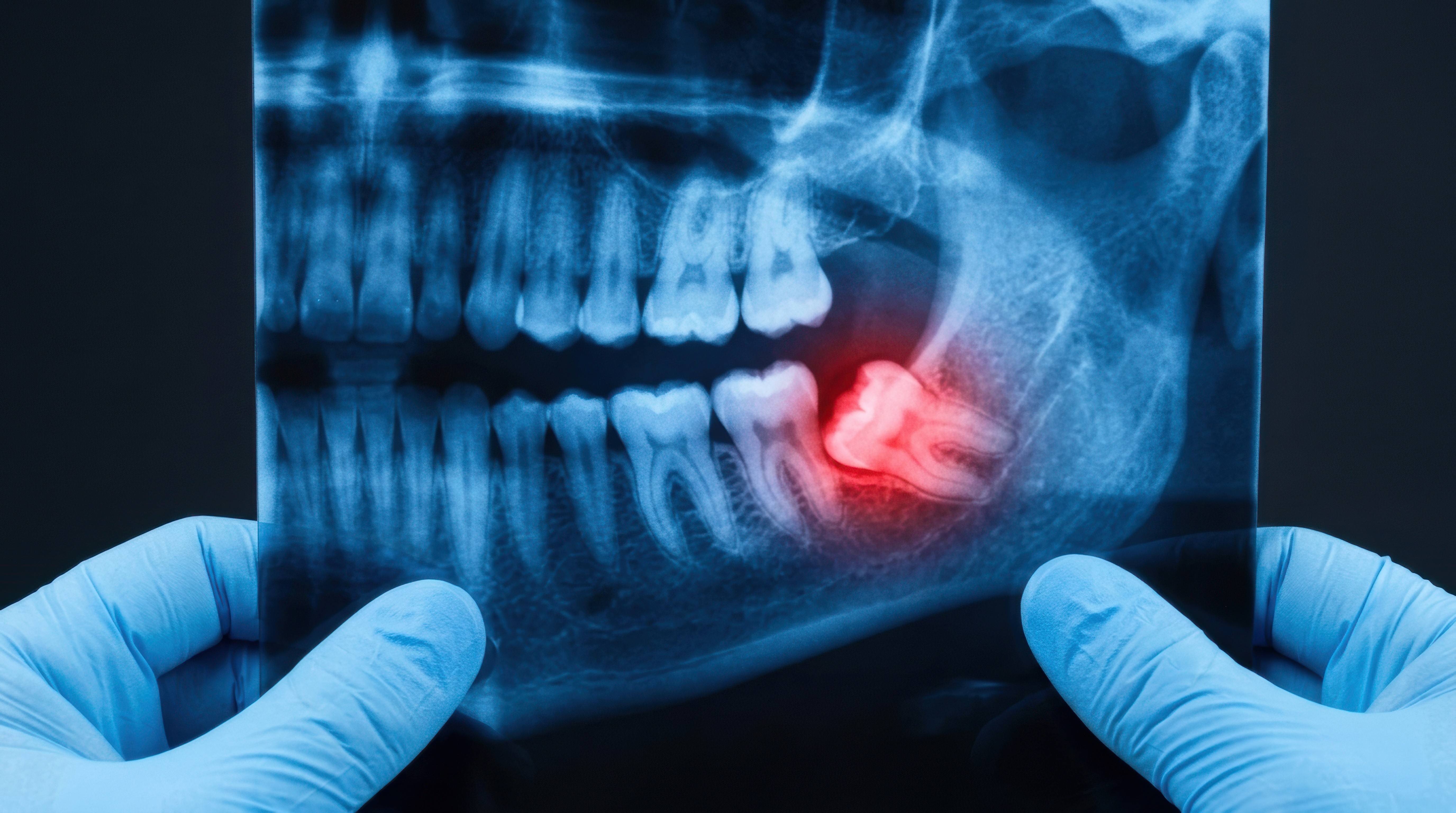 Visualização através de raio x do dente do siso no maxilar inferior.