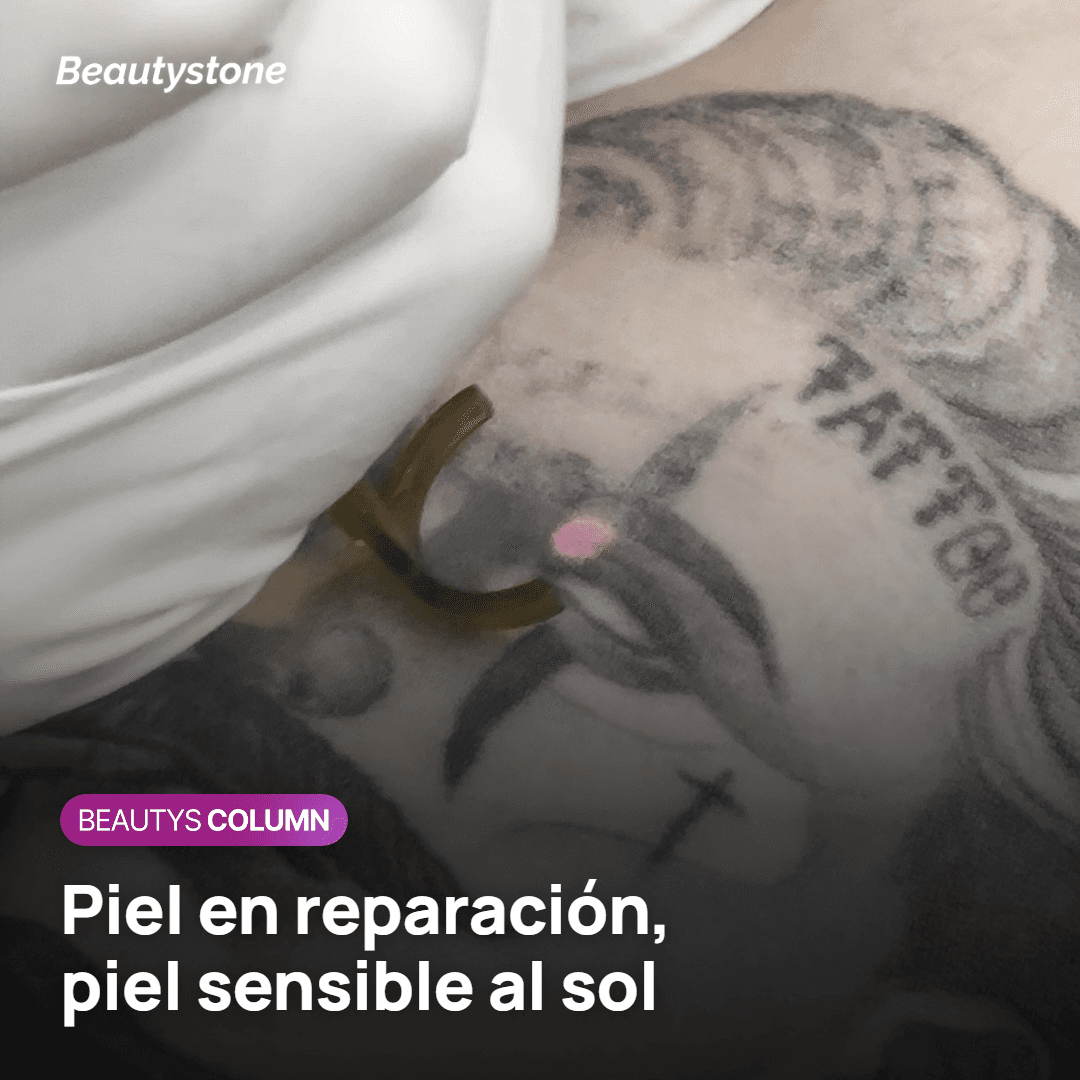 Piel tratada con láser para eliminar un tatuaje, sensible a la luz del sol