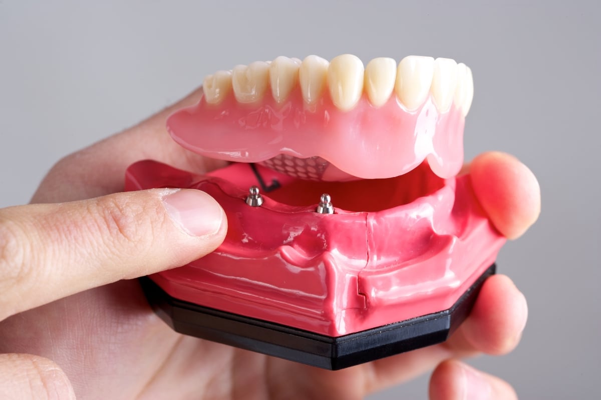 smyrna implant supported dentures