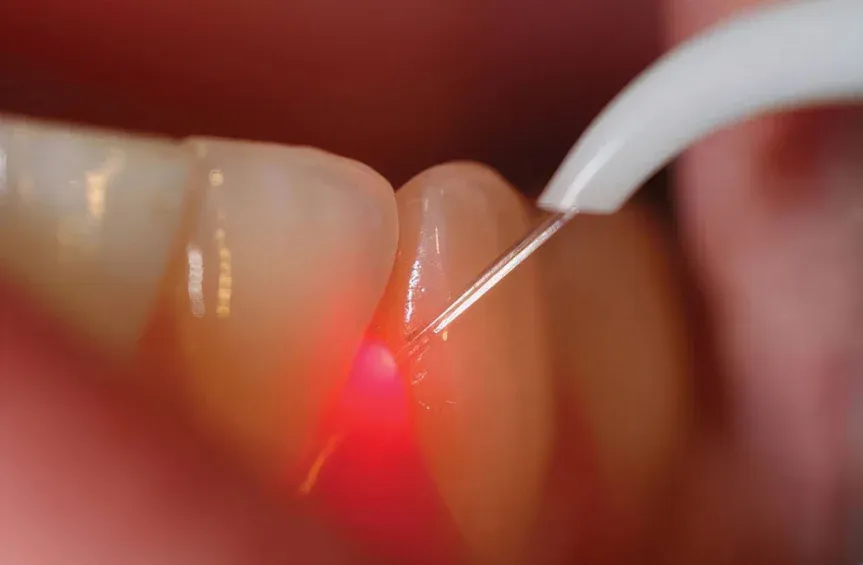 laser dentistry in smyrna