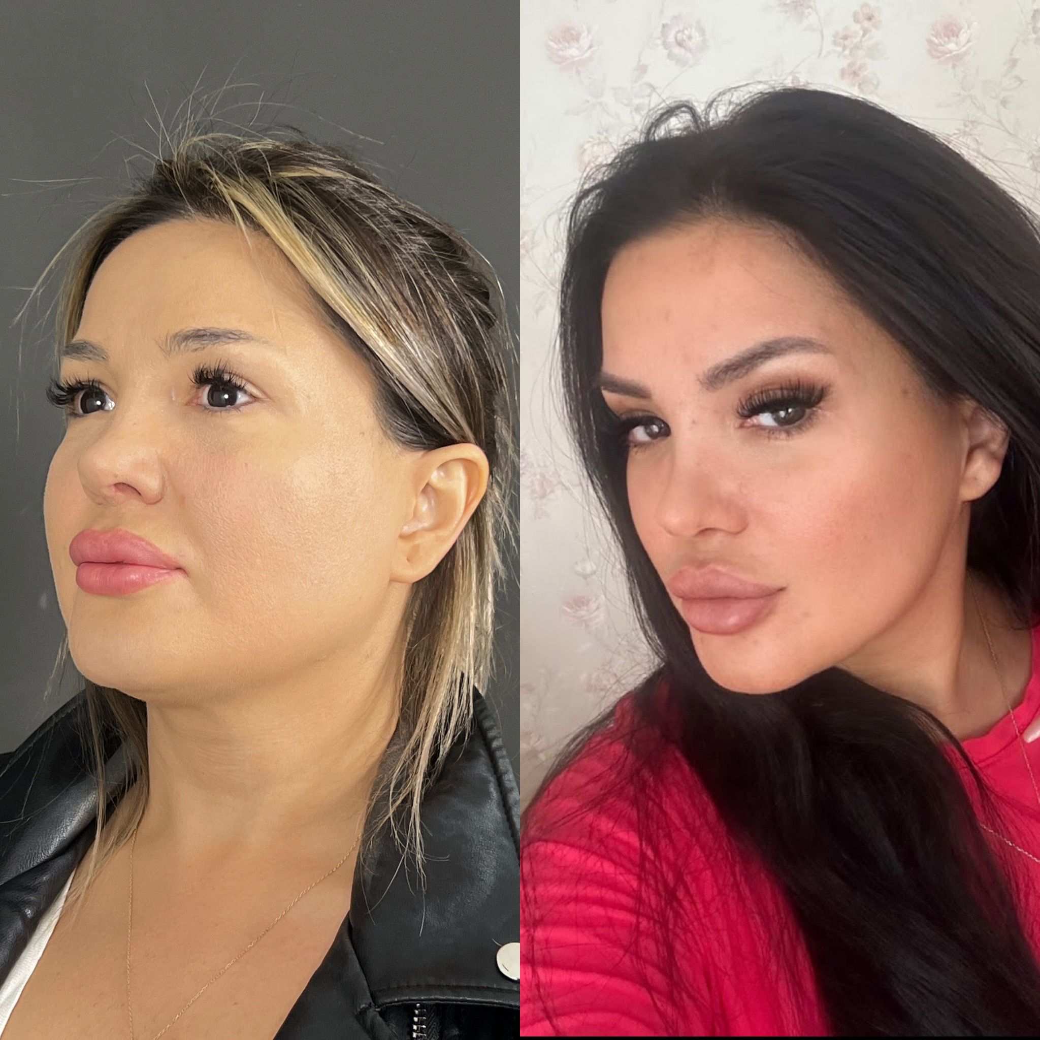 hidden scar full face rejuvenation pony tail lift before after