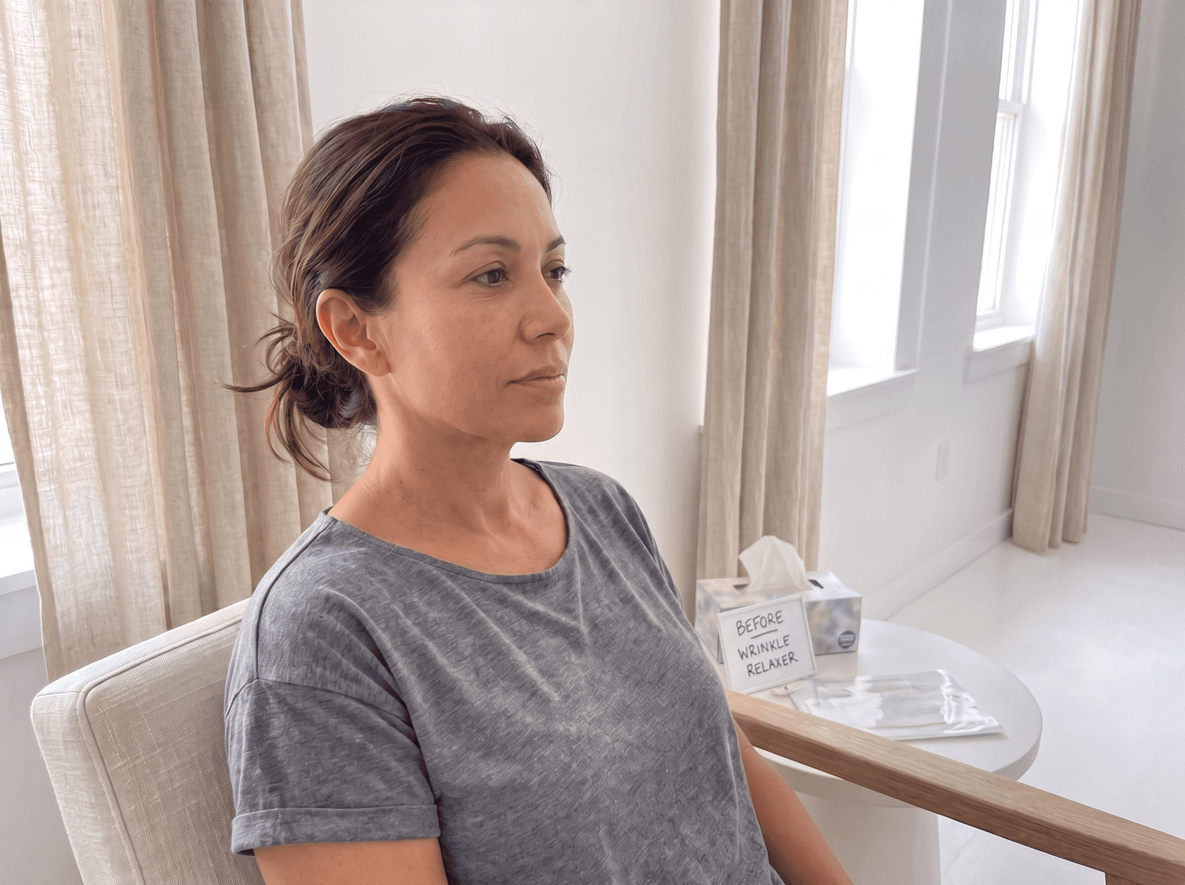 Forehead & Brows after — Wrinkle Relaxer