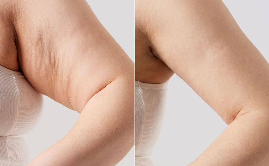 재활_르벨라주사_변화_인포그래픽_르샤인-셀룰라이트완화