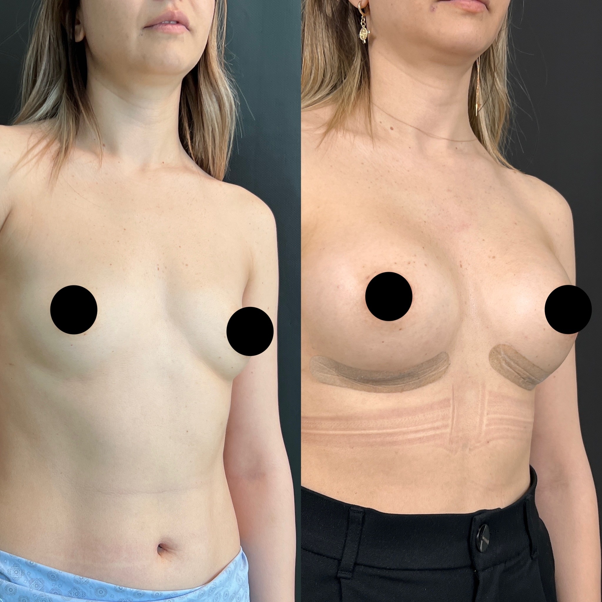 2nd week breast implant before after right oblique view