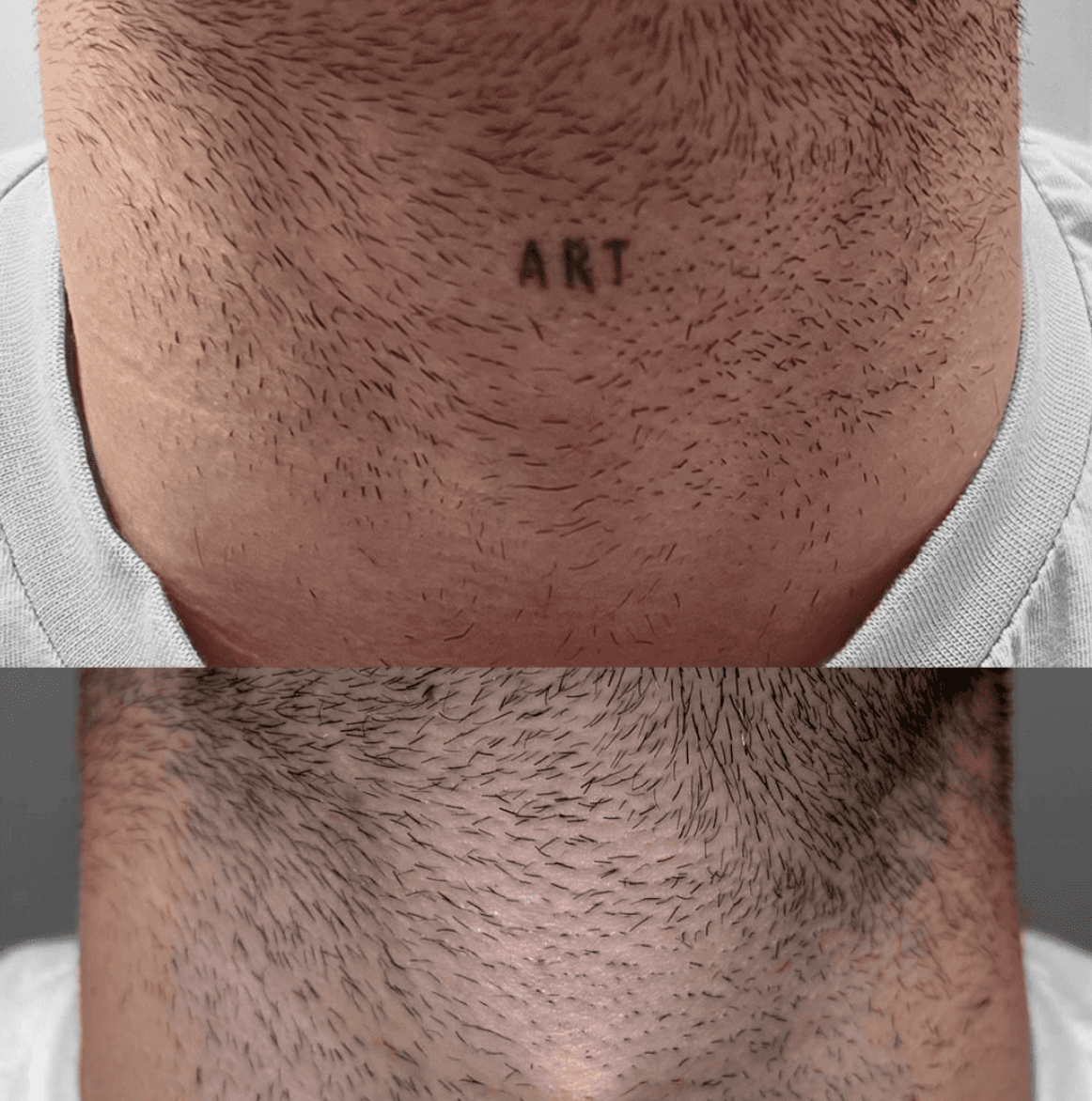 Scalp Micropigmentation Schweiz