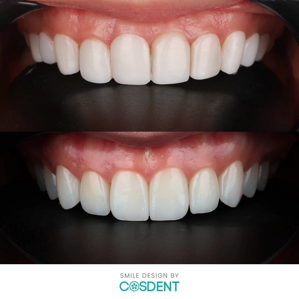 รีวิวออกแบบรอยยิ้ม ที่ cosdent smile design