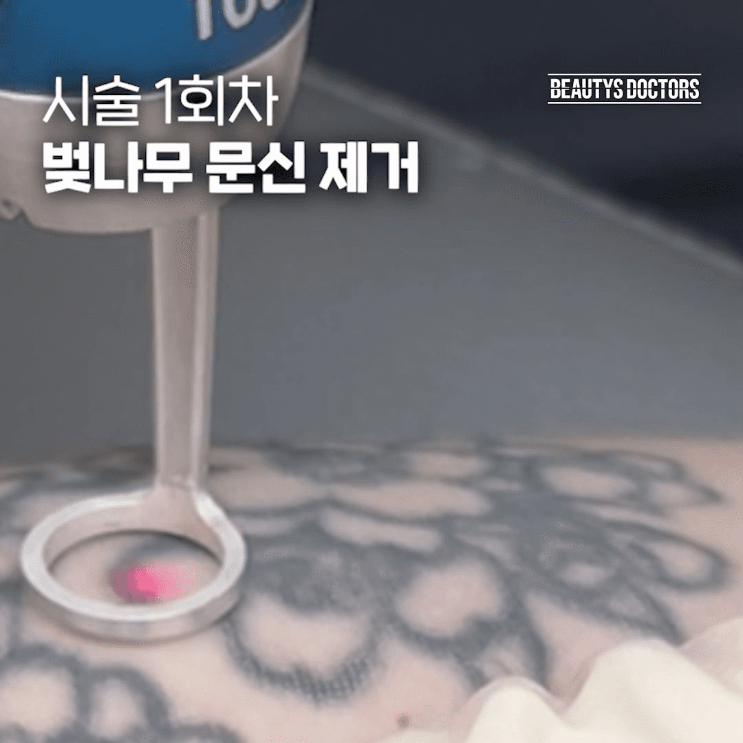 컬러 문신 지우기 전에 꼭 물어보세요, "이 파장 지원하나요?"