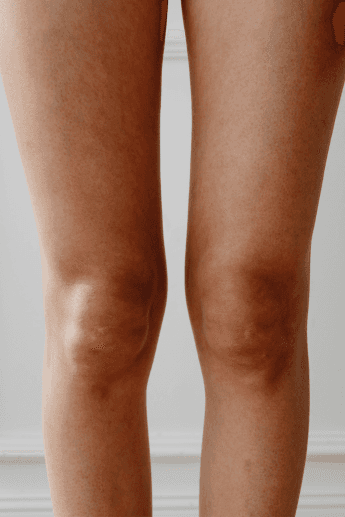 Lipedema ou retenção de líquidos? Como diferenciar os sinais