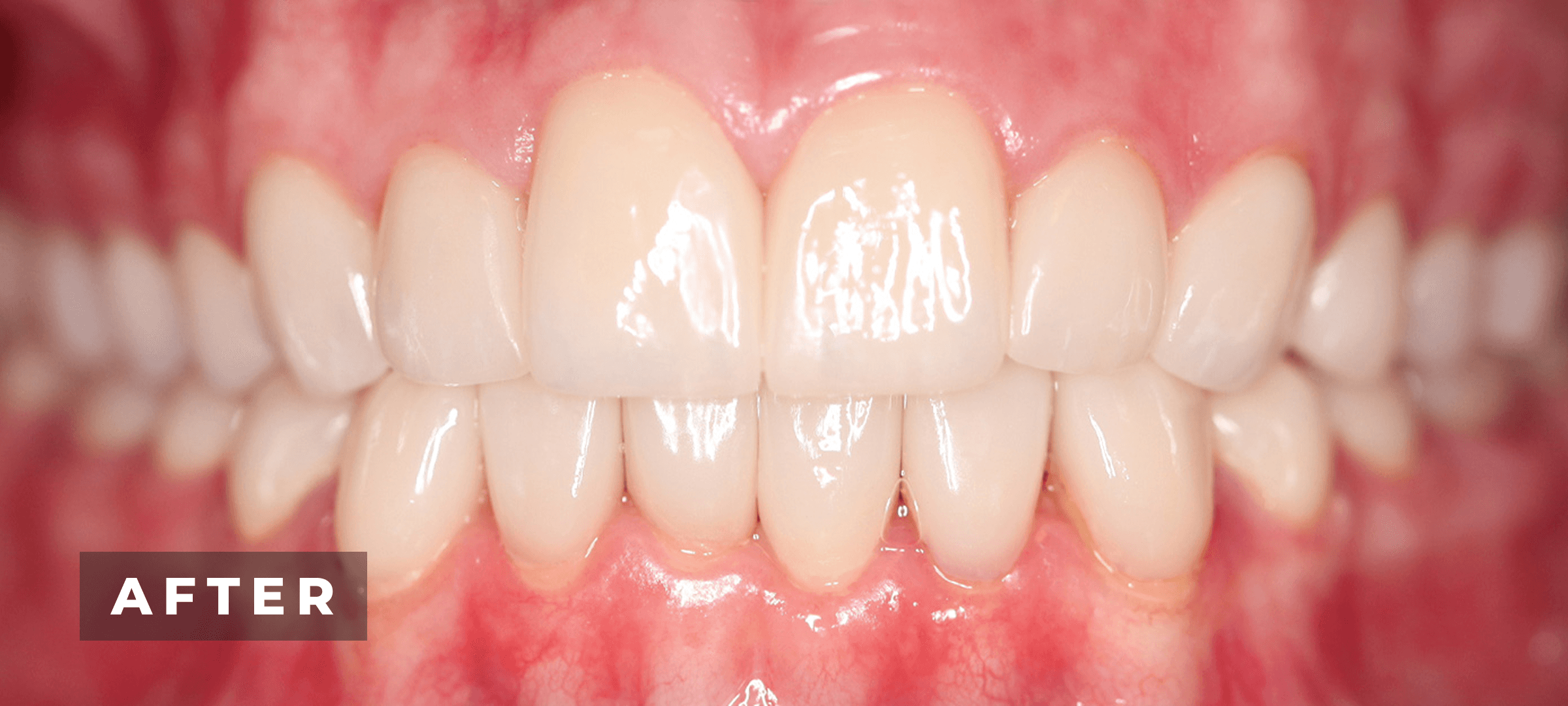 After image of veneer & full mouth rehabilitation