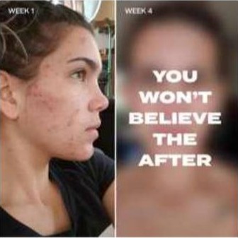 Skincare brand static ad: week 1 and week 4, you won't believe the after