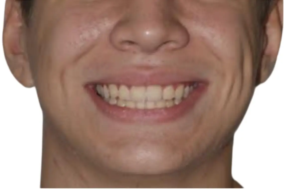  Cambiamenti positivi nel carattere accompagnati da una maggiore fiducia in se stessi. Riequilibrio del sorriso e della simmetria cranica e facciale
