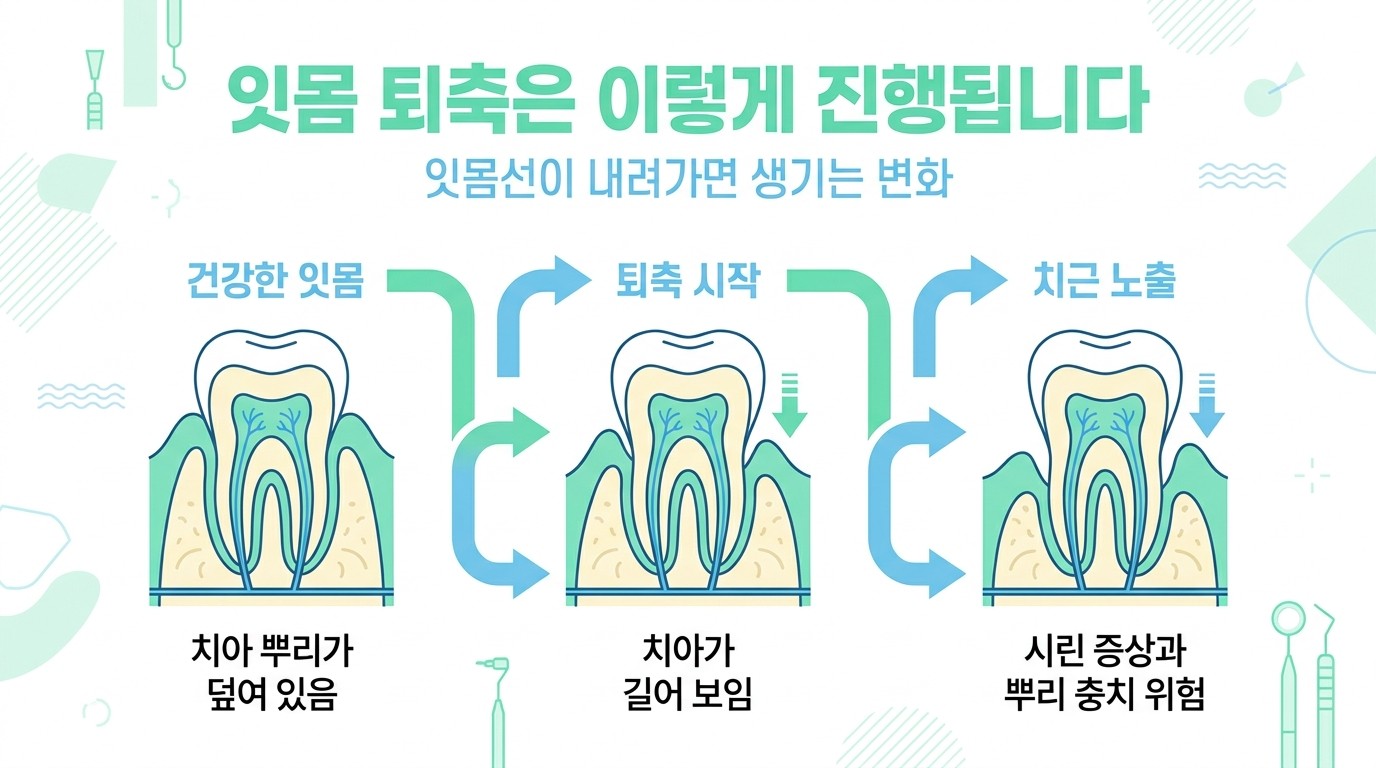 잇몸 퇴축 진행 단계 인포그래픽