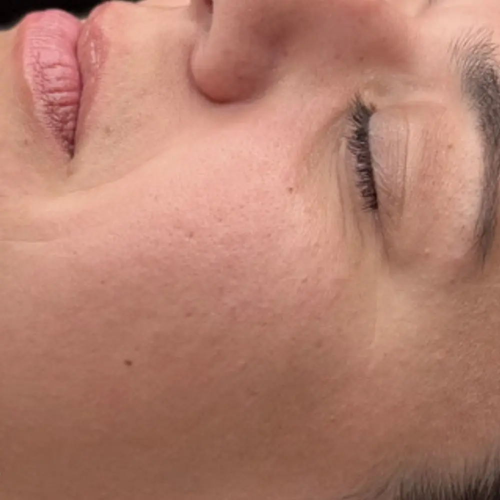 Before lymphatic drainage facial at The Vancouver Aesthetician — visible fine lines and dehydrated skin lacking moisture and radiance
