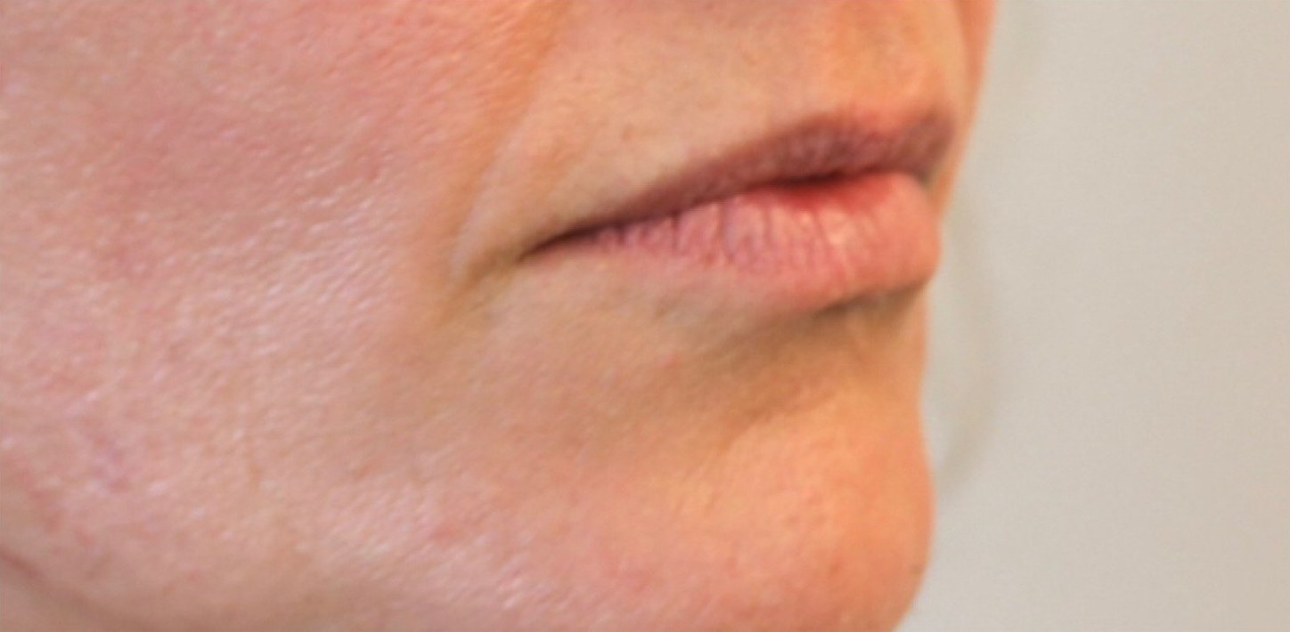 Before: close-up of lips in profile.