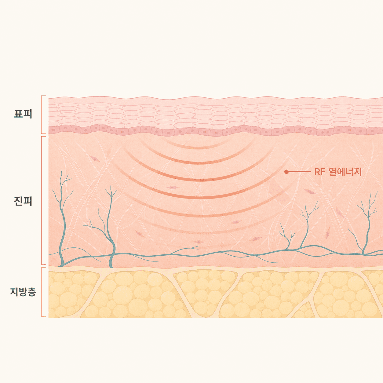 표면은 식히고 진피에 열을 전달하는 온다리프팅 원리