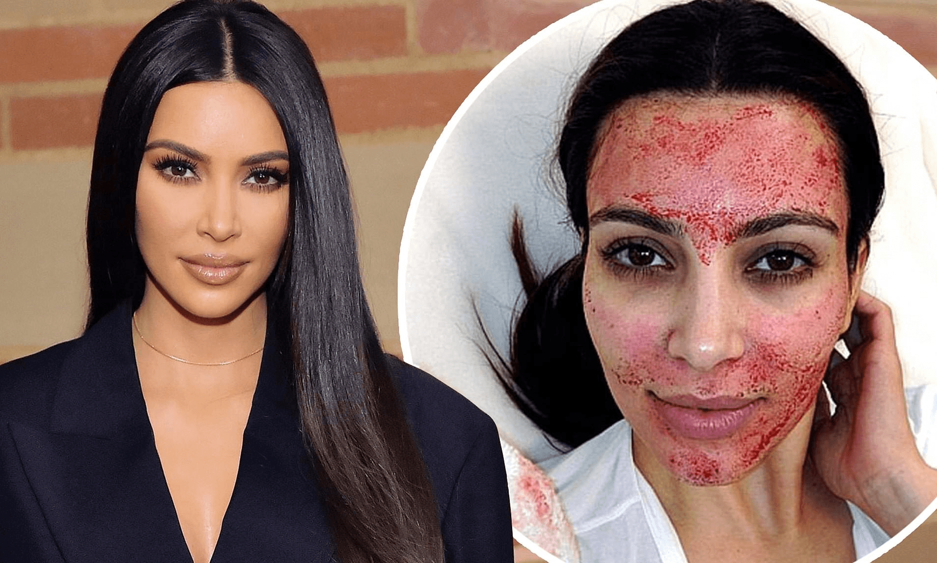 Kim Kardashian before and after a vampire facial treatment.