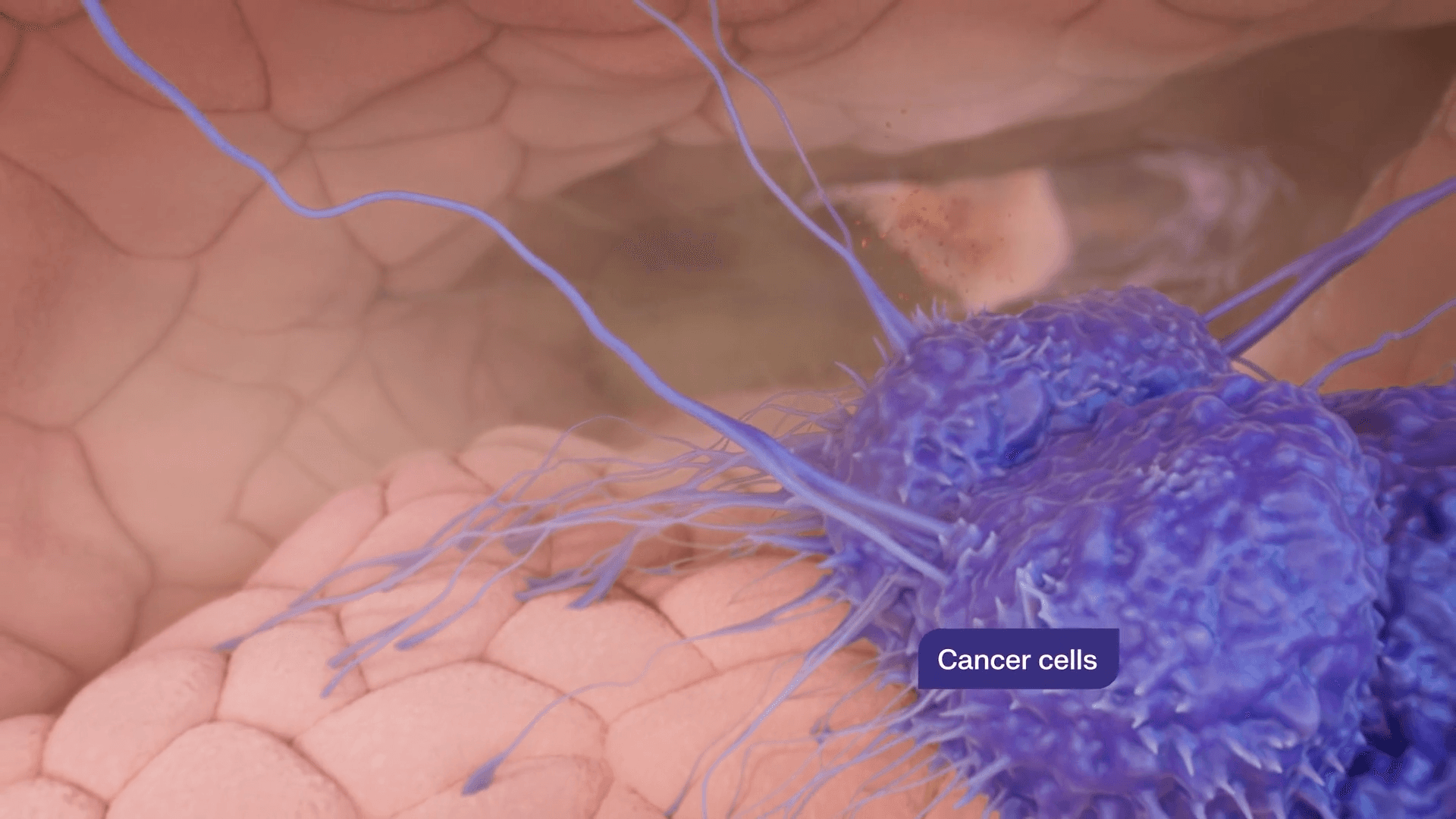 Cancer cells in the tissue