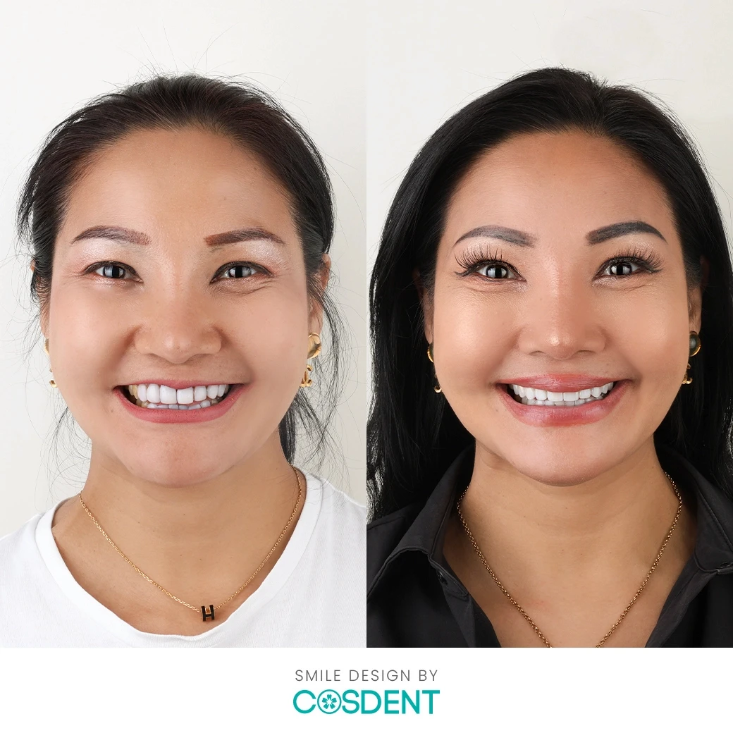 รีวิวออกแบบรอยยิ้ม ที่ cosdent smile design