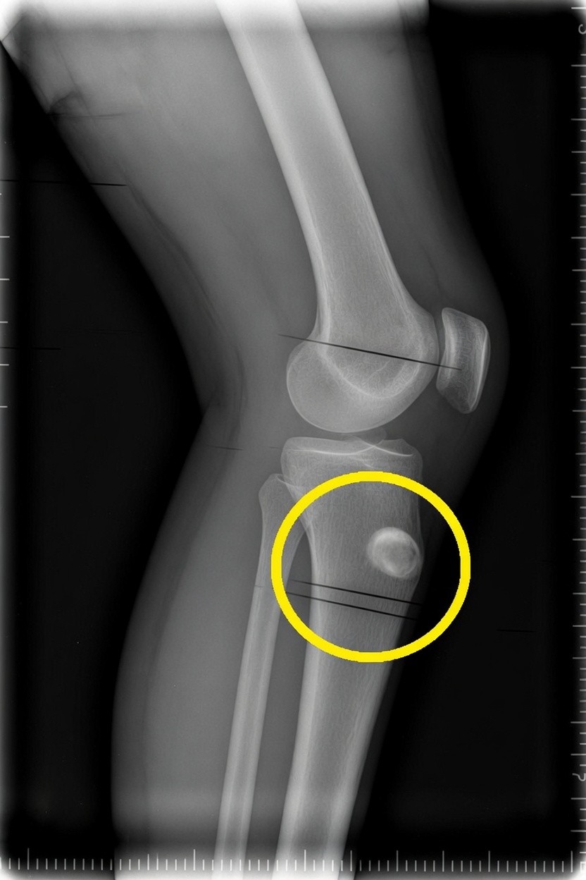 Lateral X-ray of a child’s knee with yellow circle marking the tibial tubercle apophysis