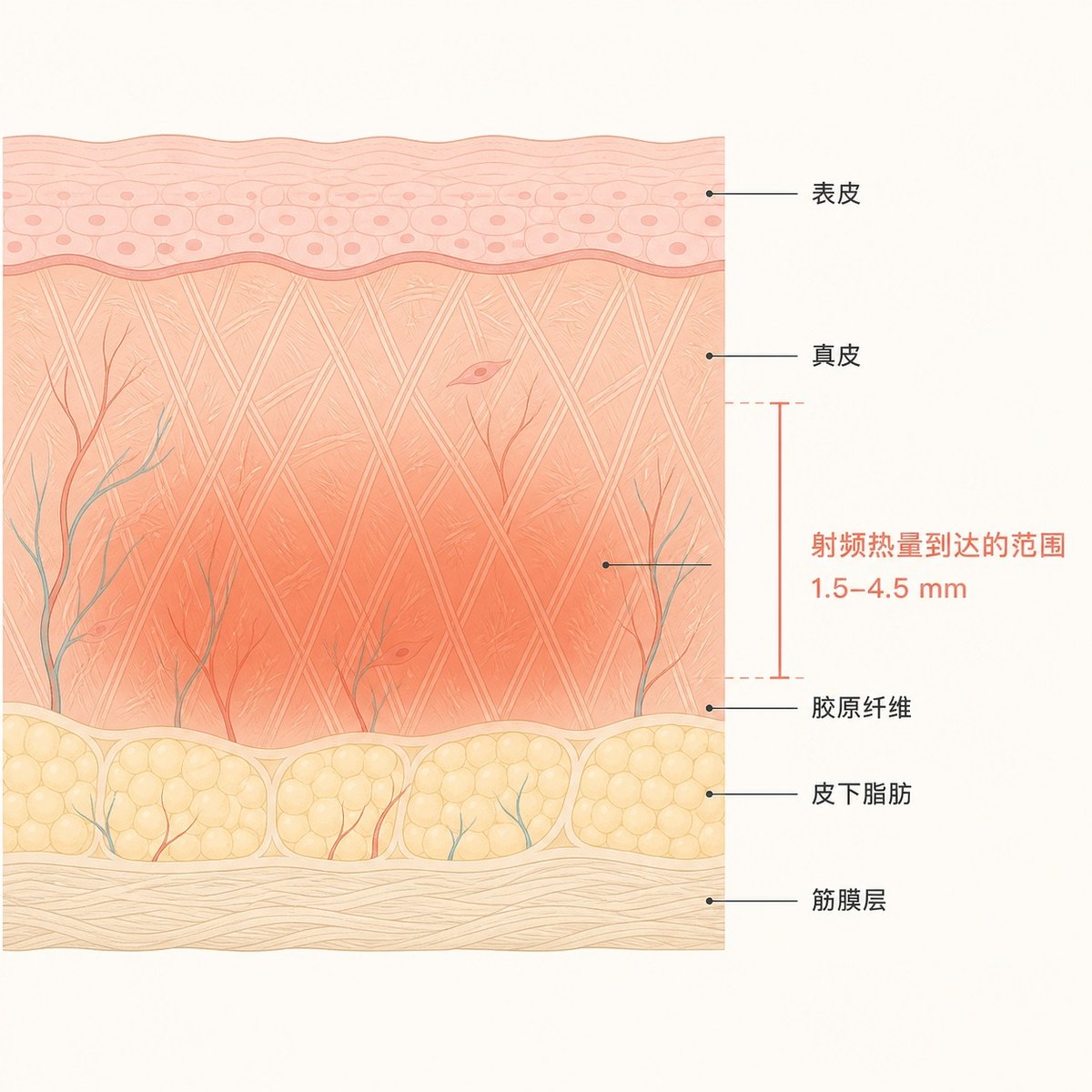 面部皮肤的断面图，标出表皮、真皮、皮下脂肪与筋膜层的位置，以及射频热量在深层真皮扩散的范围