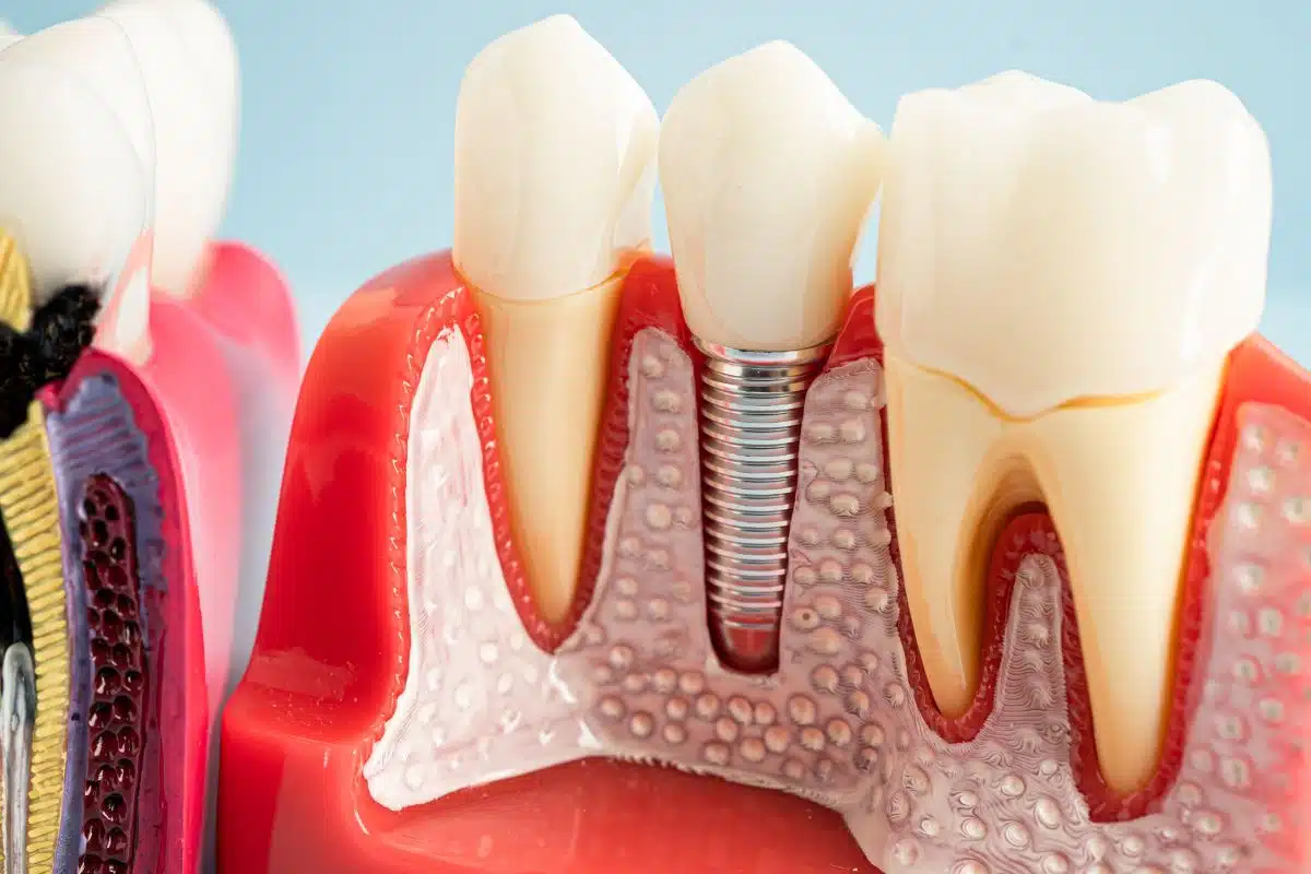 dental implants