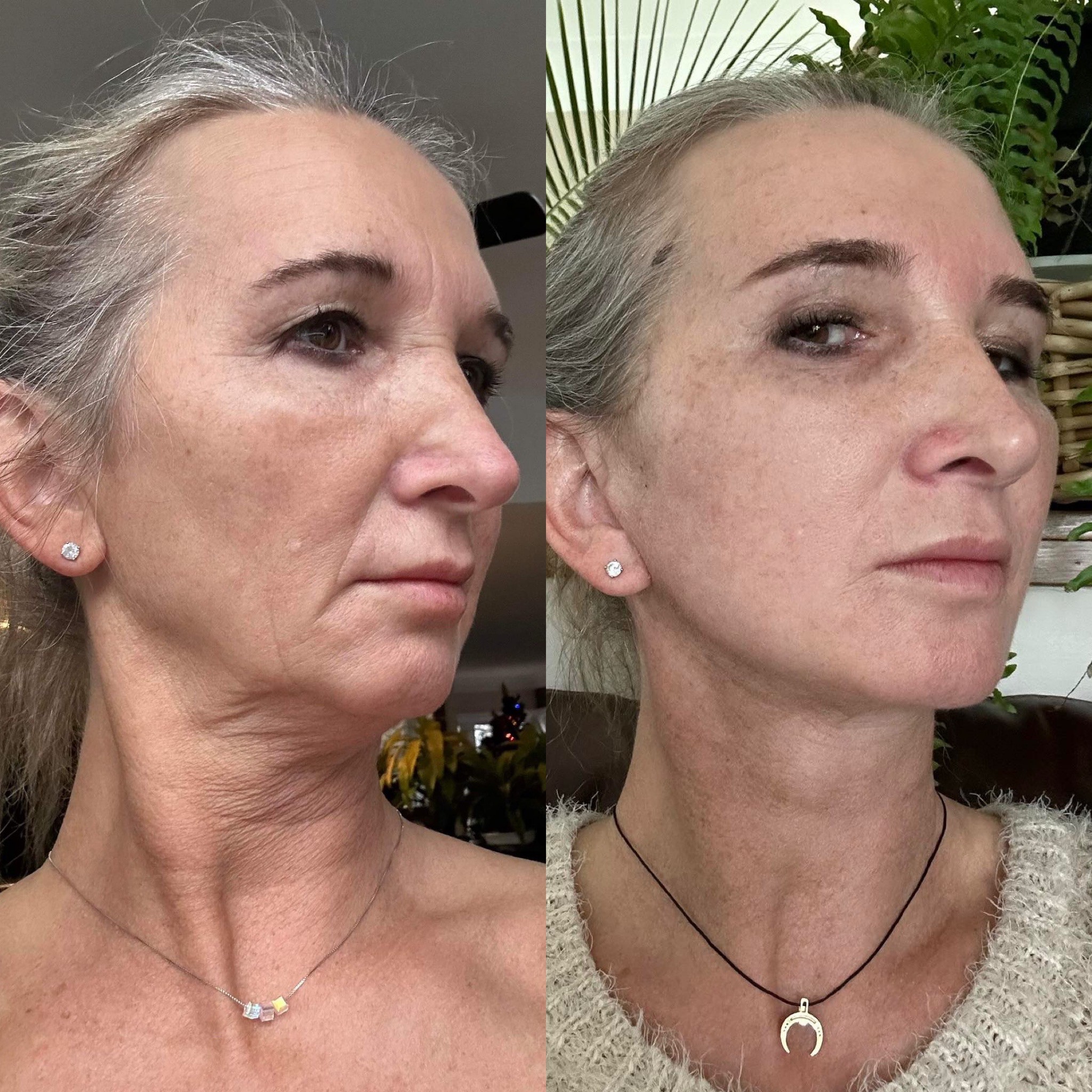 2 months post-op deep plane face neck lift and browlift before after right oblique view