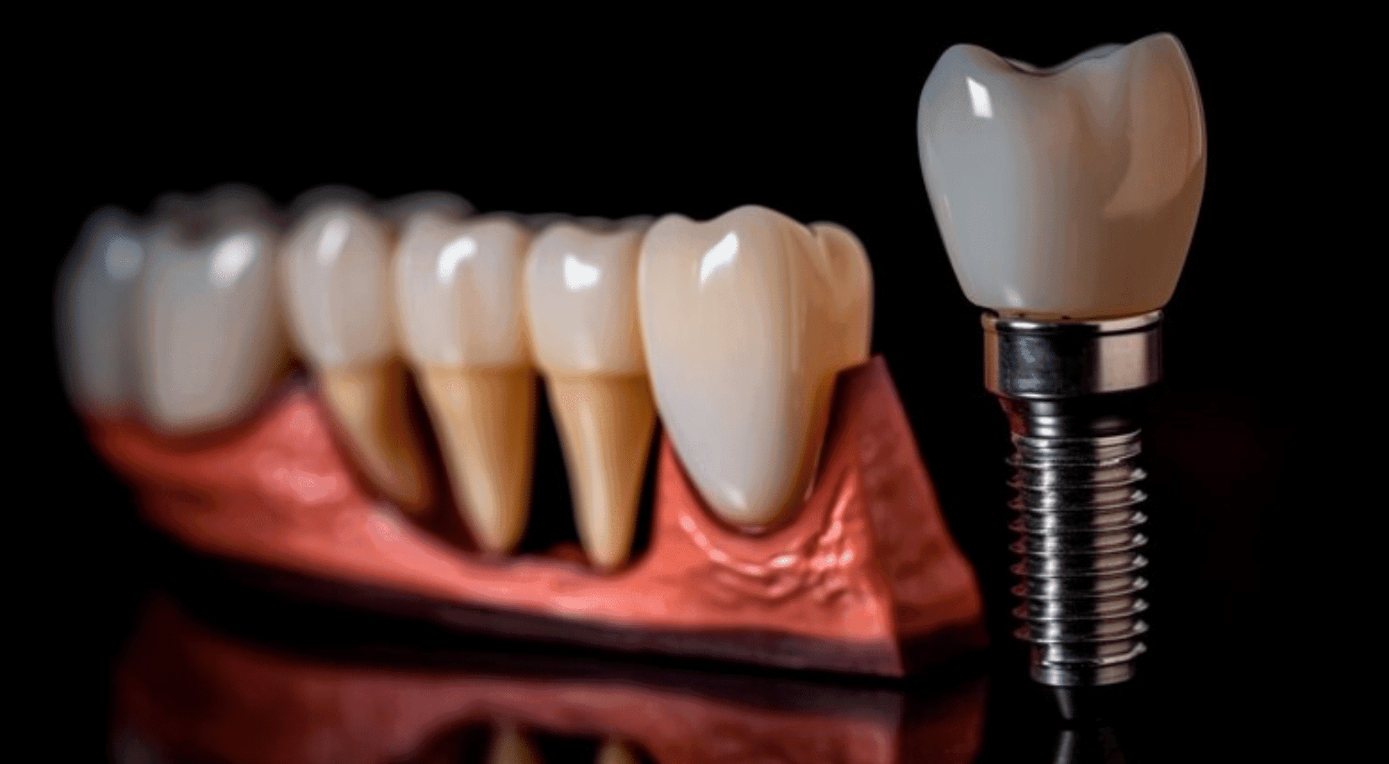dental implant
