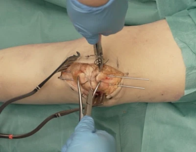 Patellar fracture fixation with tension band