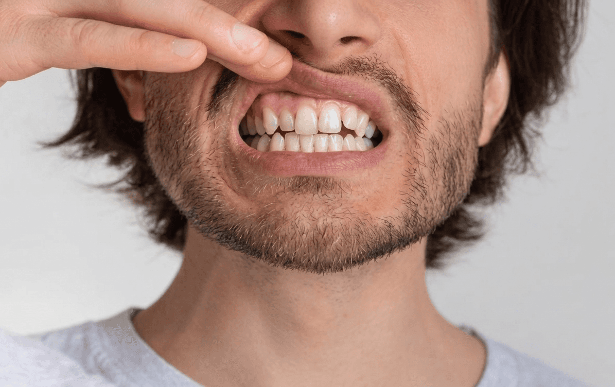 Man showing crowded teeth and visible dental misalignment in the front teeth.