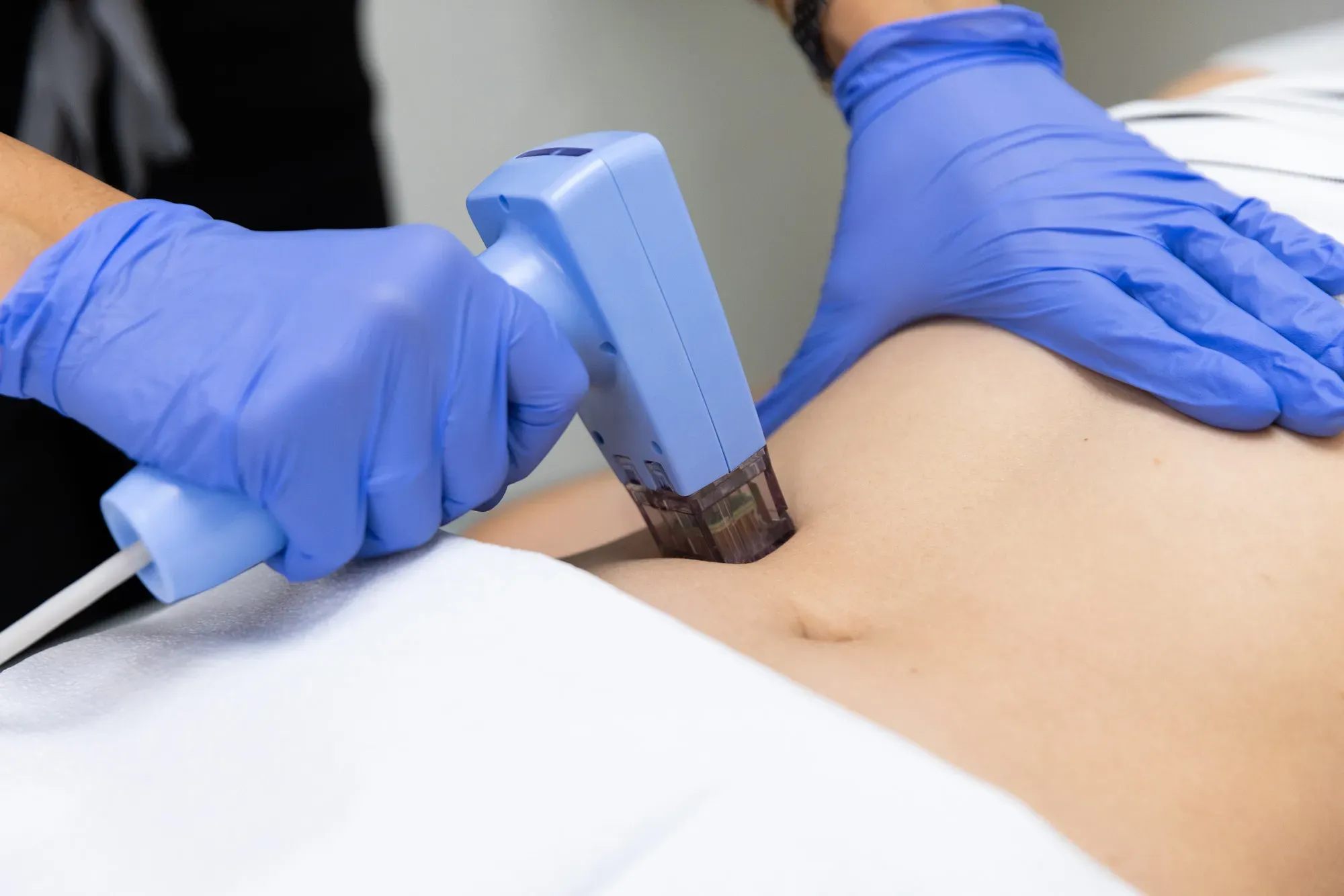 Patient receiving Morpheus8 microneedling with radiofrequency treatment to tighten skin, reduce cellulite, and improve tone for smoother results.