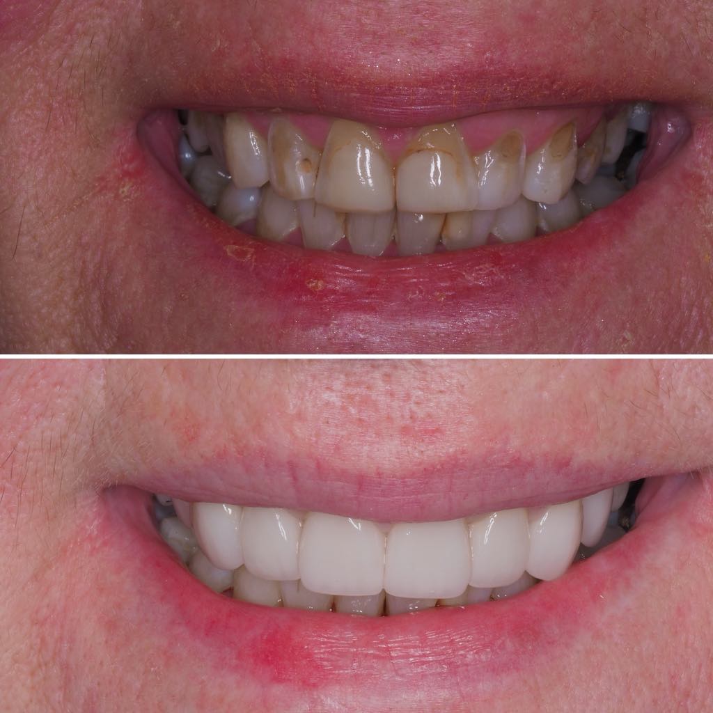 Before & After