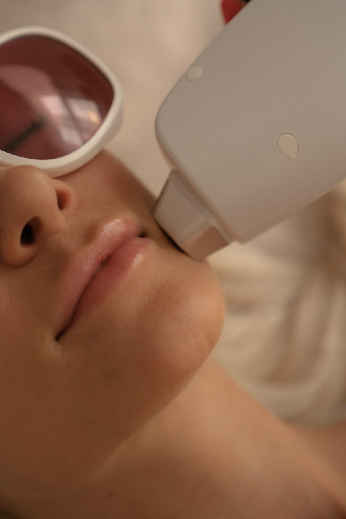 Acne Laser Treatment Being Performed