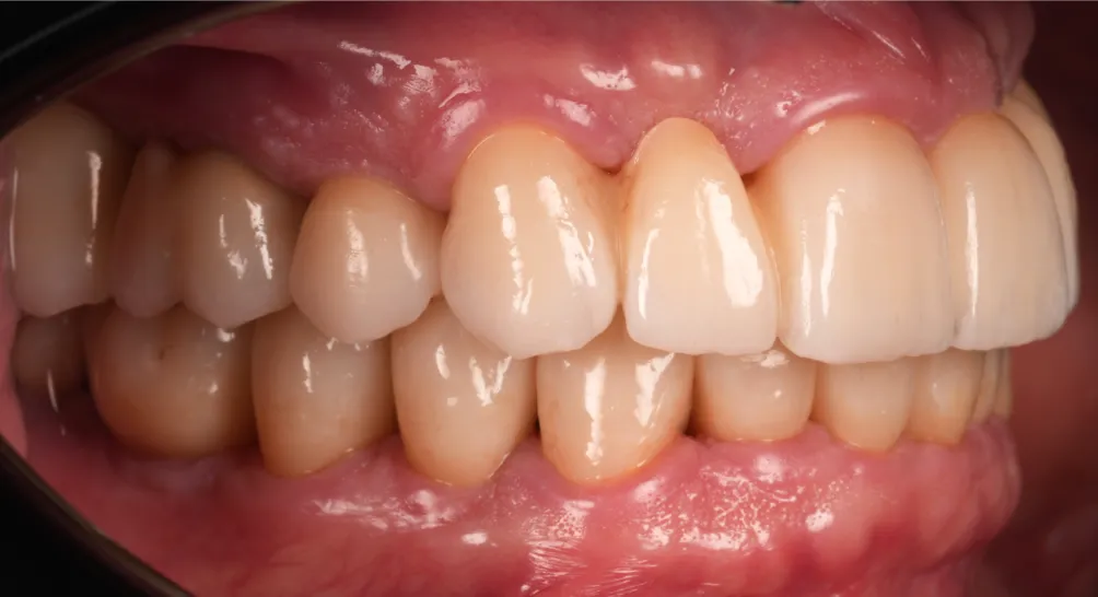 After prosthetic rehabilitation