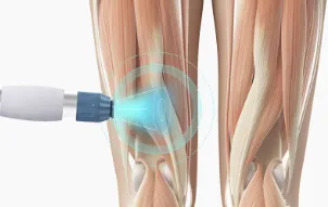 체외충격파 치료가 무릎 조직에 전달되는 원리를 설명한 의료 이미지