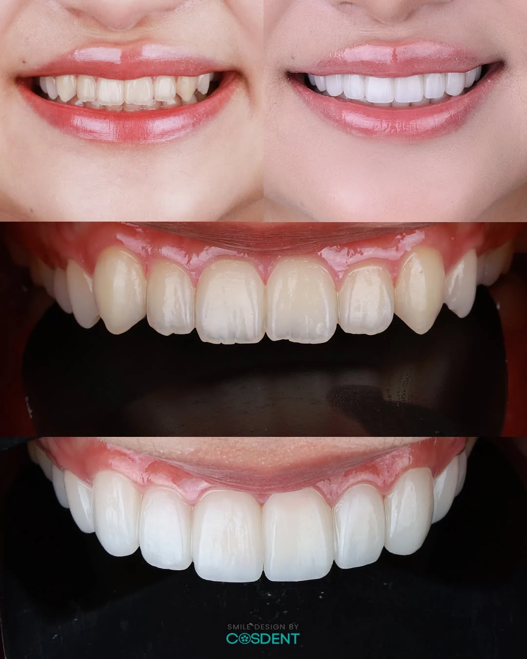 Smile comparisons and close-up views showing changes in upper front tooth appearance.