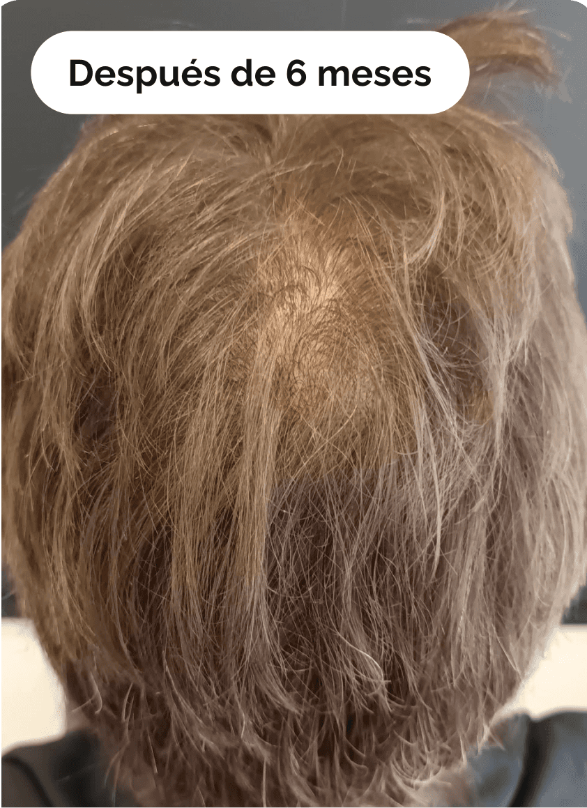alopecia androgénica
