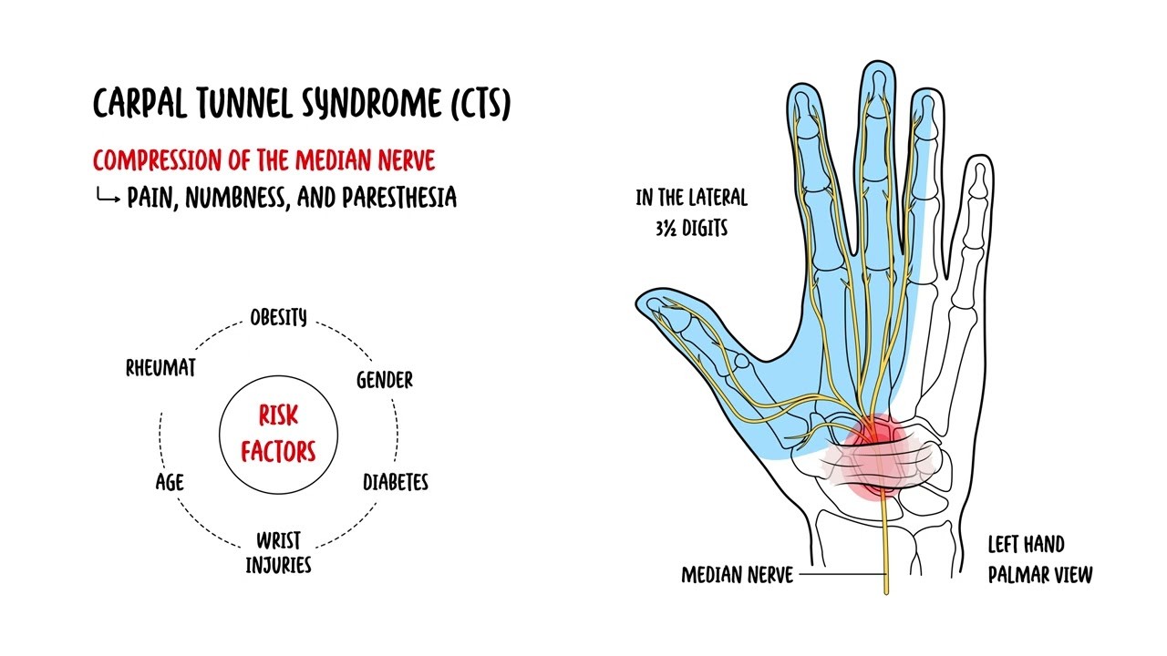 Infographic showing where carpal tunnel happens in the hand and displays 6 risk factors that contribute to carpal tunnel syndrome