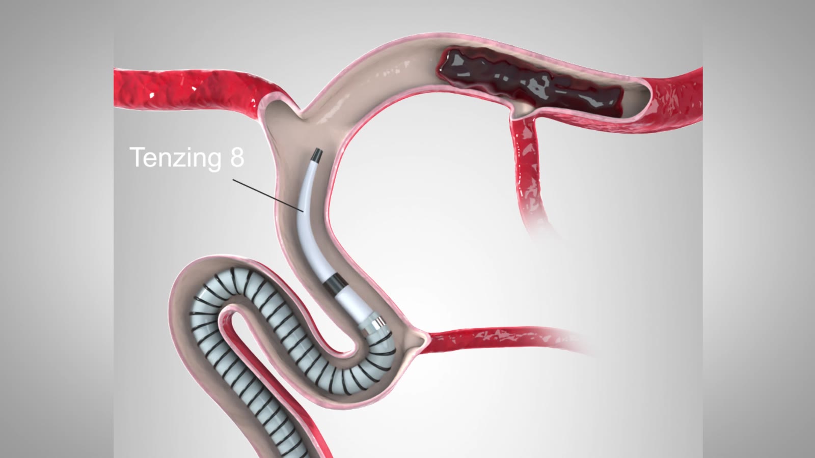 Massari Catheter