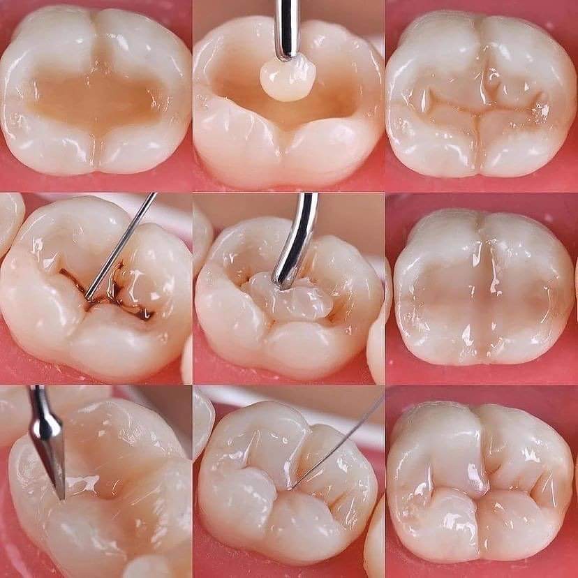 Dental Filling