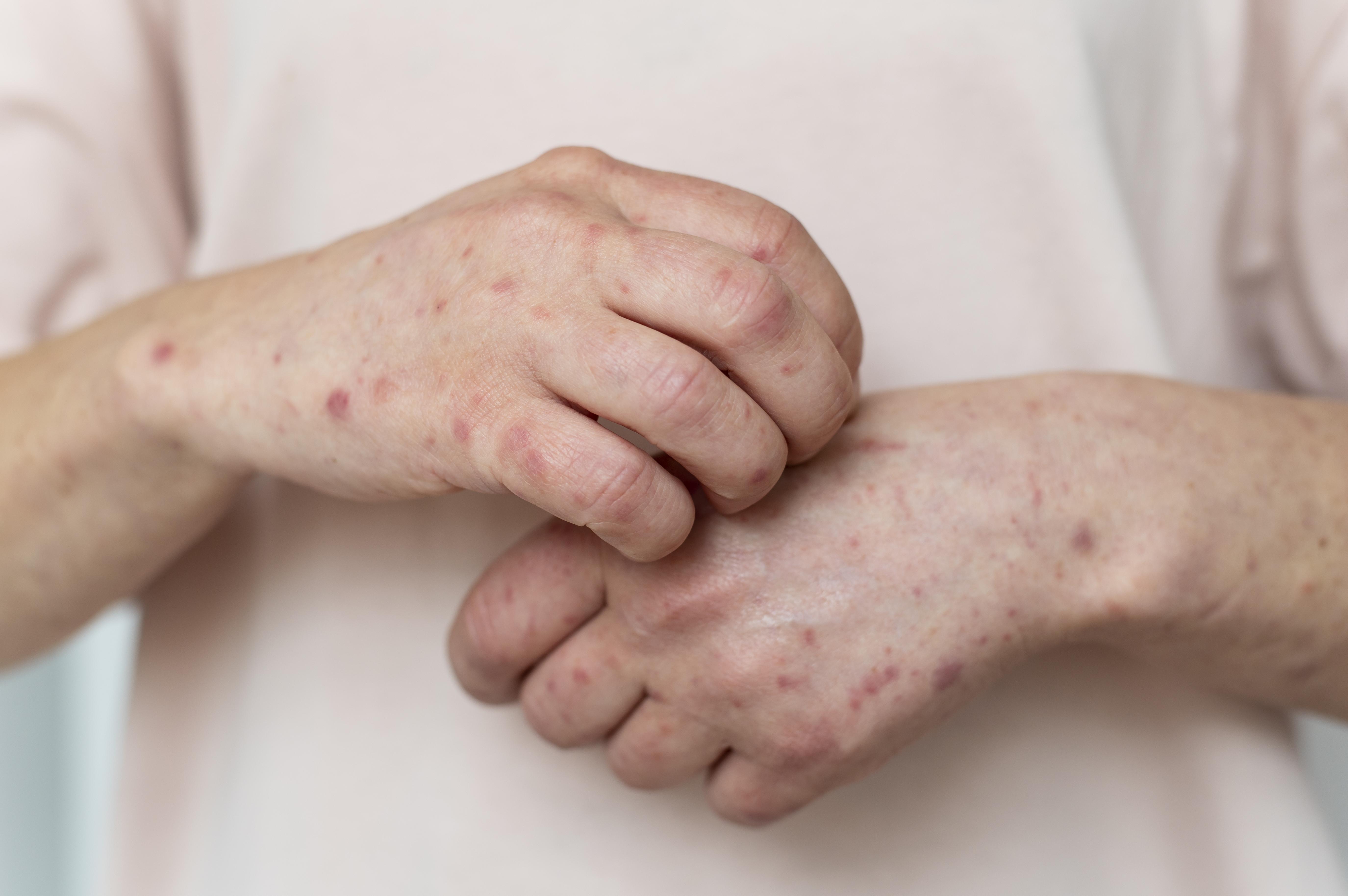impetigo treatment in nairn