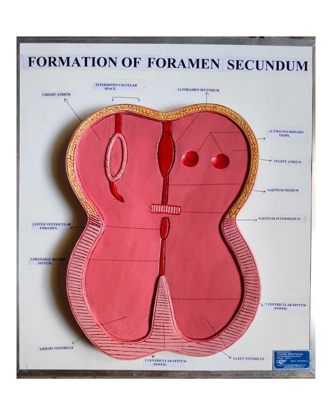 Formation of Foramen Secundum