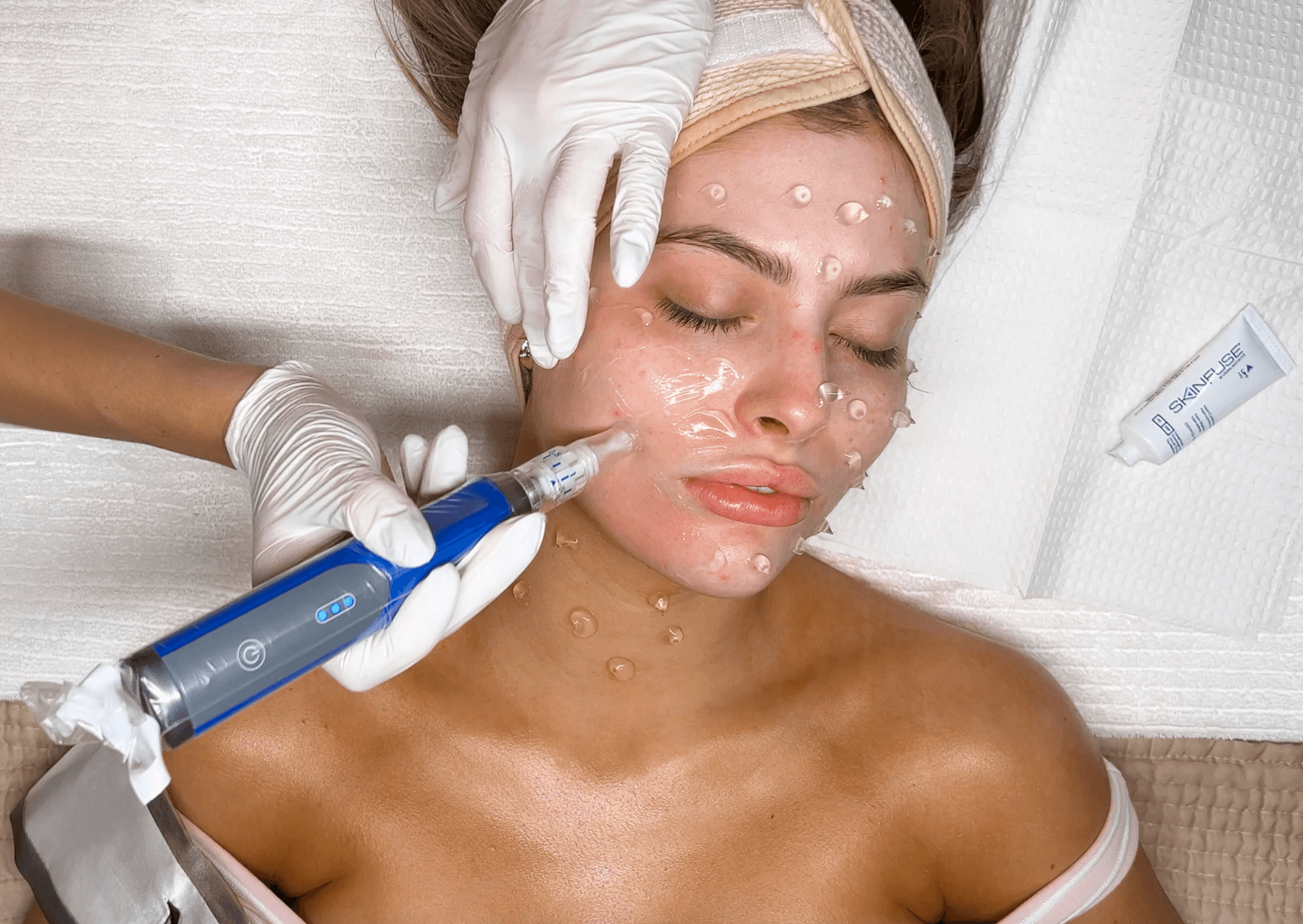 SkinPen® Microneedling to pair with resurfx fractional laser