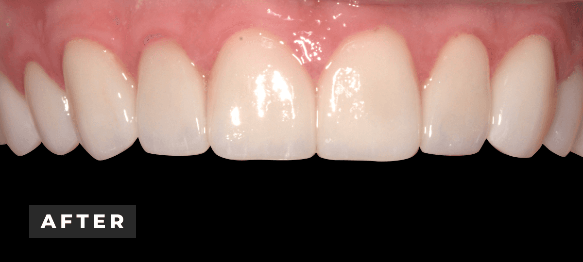After image of porcelain veneer and invisalign