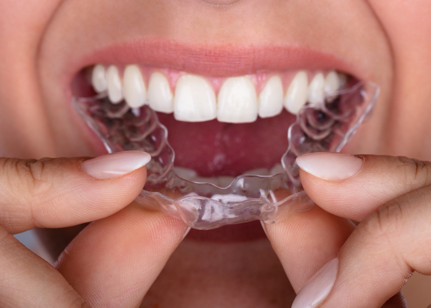 Como colocar goteira dentária