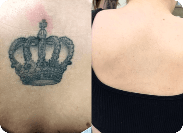 Imagem de antes e depois da remoção de tatuagem